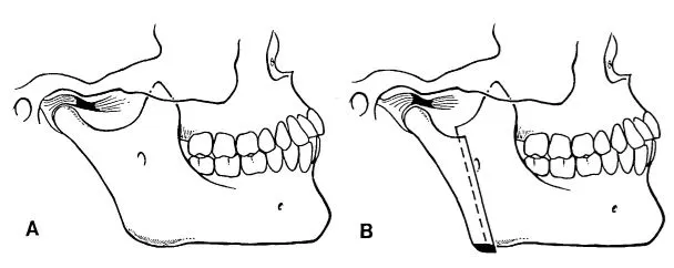 Condylotomy Rancho Santa Margarita CA, Orange County Surgical Specialists